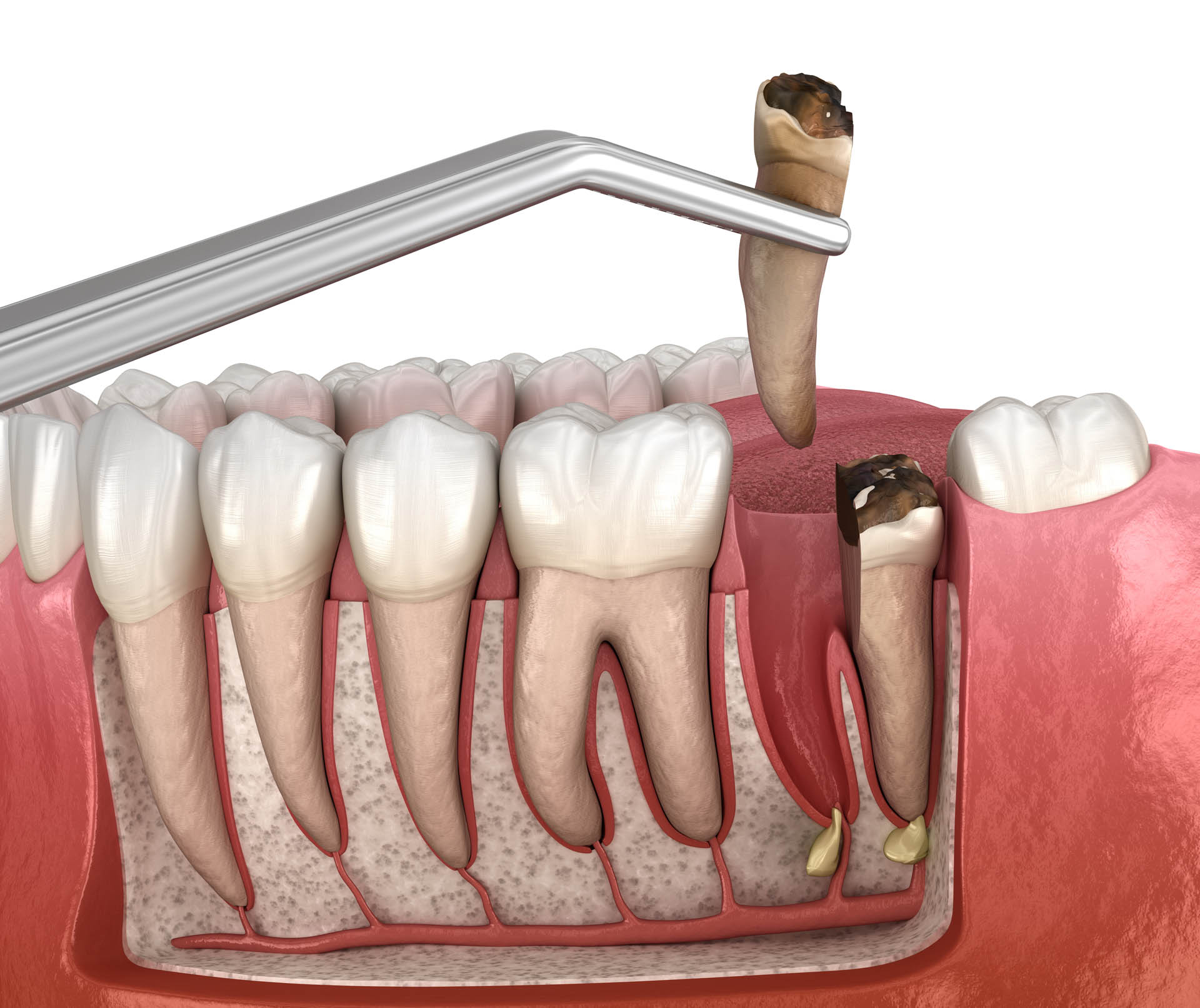 Dental Extraction